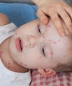 Barn med skoldkopper