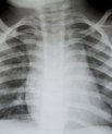 Kronisk obstruktiv lungesygdom har store konsekvenser for mange danskere.