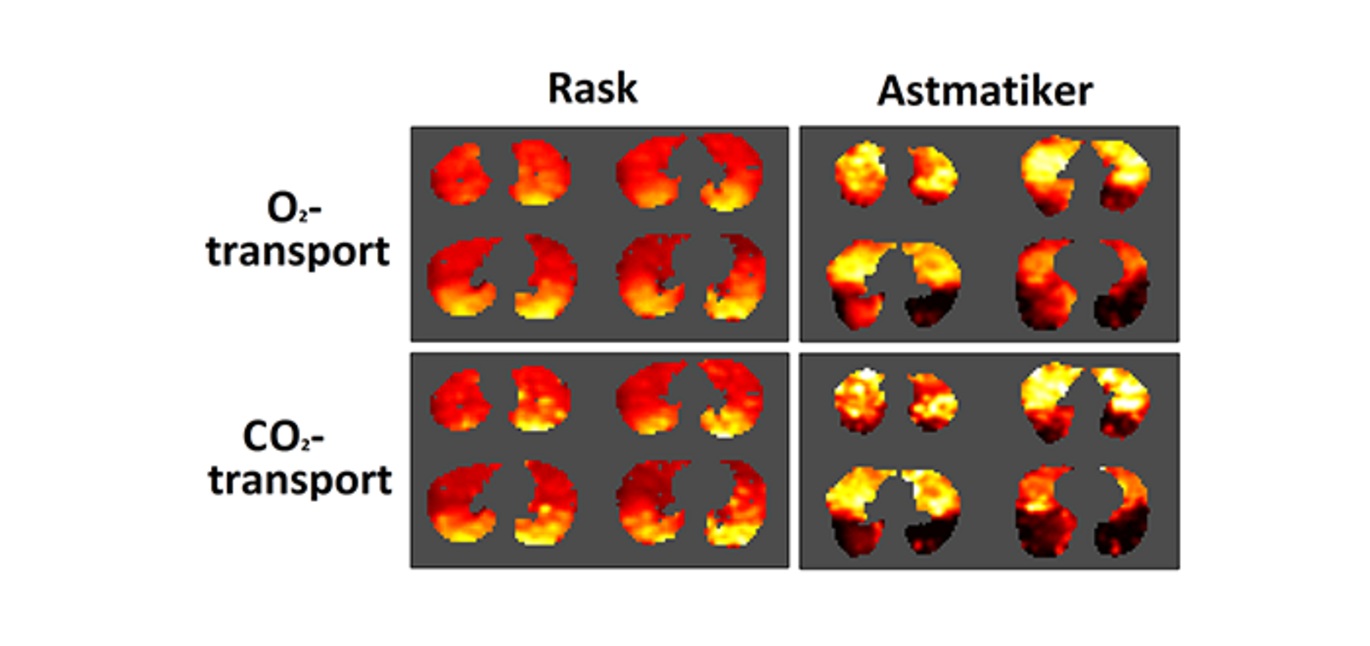 Ovenstående viser billeder af lungernes ilt –og CO2-transport for henholdsvis en rask person (til venstre) og en astmatiker (til højre).